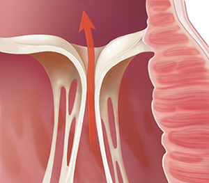 Close-up of heart valve unable to completely close.