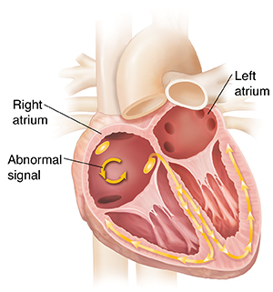 Cross-section of heart with atrial flutter, showing abnormal signs in atria.