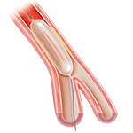 Cross section of artery with catheter and inflated balloon.