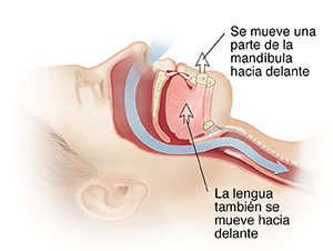 Vista lateral de la cabeza con una flecha que muestra el paso del aire a través de los conductos nasales hacia la tráquea. Las flechas indican que la mandíbula se movió hacia adelante después de la cirugía.