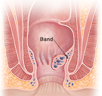 Corte transversal de ano que muestra una ligadura de hemorroides con banda elástica.