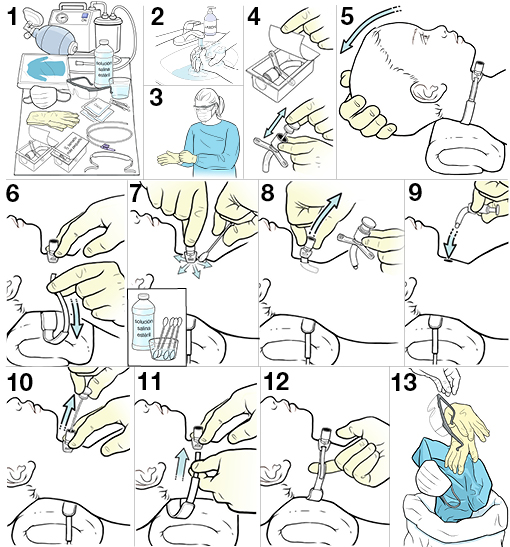 Trece pasos para cambiar la traqueostomía de un niño.