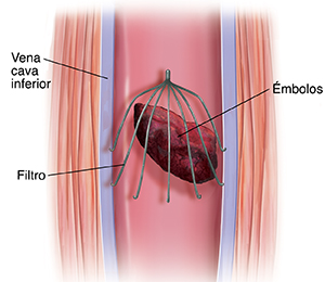 Corte transversal de la vena cava inferior con un filtro para atrapar émbolos.