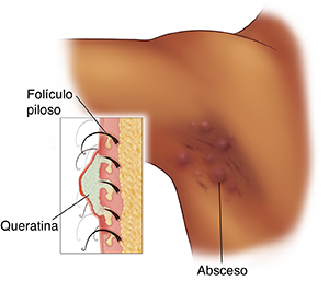 View of armpit showing red bumps and inflammation. An inset shows buildup in the hair follicles. 