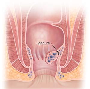 Corte transversal del ano donde pueden verse hemorroides con bandas.